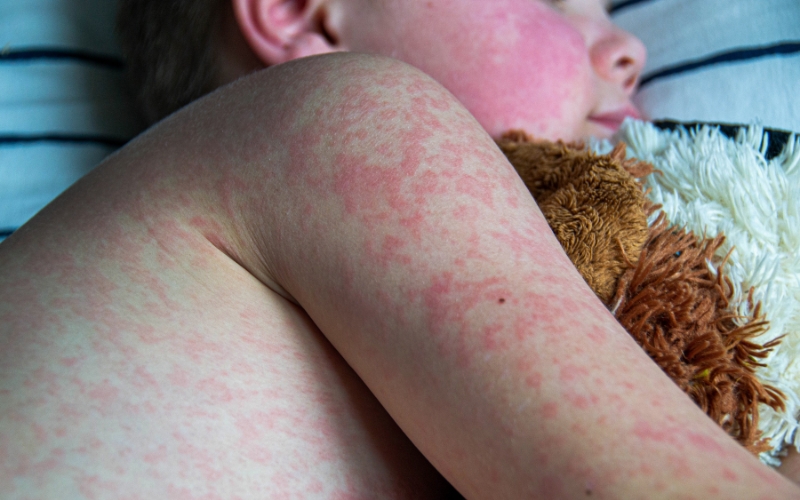 Child with measles
